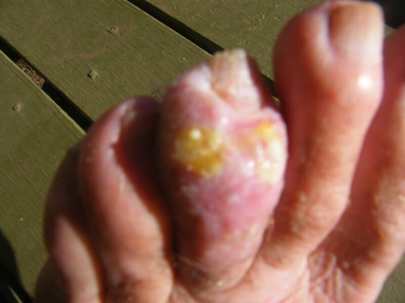 What does gout on feet look like?