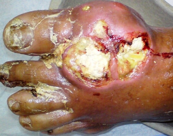 Medical Definition of Tophaceous gout - MedicineNet