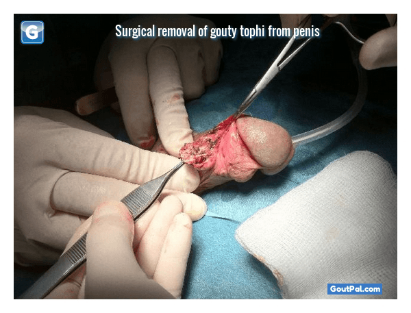 Gouty Tophus Removal
