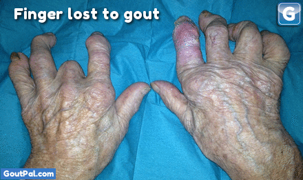 Gouty Fingers Case Learning Points