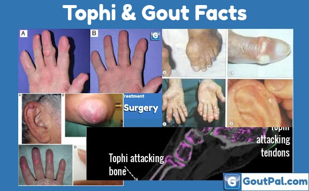Tophi & Gout Facts