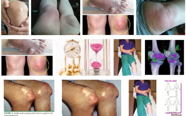 Which Gout Knee Picture tells your story?