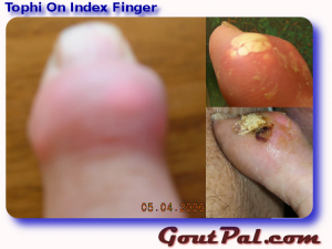 Tophi On Index Finger Photographs