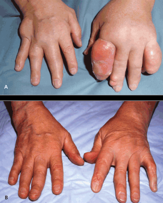 Tophaceous Hands Photograph