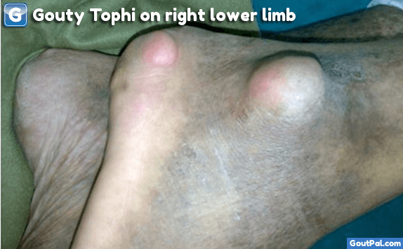 Gouty Tophi On Right Lower Limb Photograph