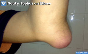 Gouty Tophus On Elbow Photograph