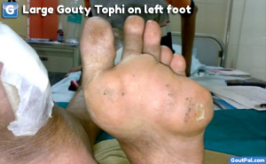 Large Gouty Tophi On Left Foot Photograph