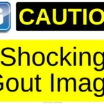 Shocking Gout Image