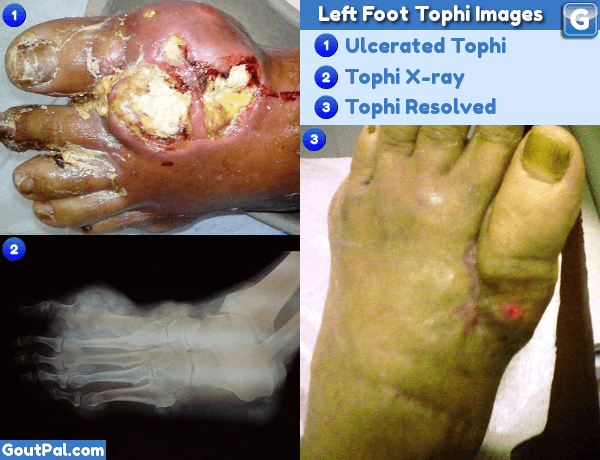 Left Foot Tophi Images