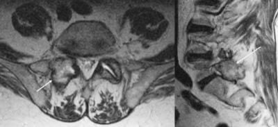 Gout in Back MRI