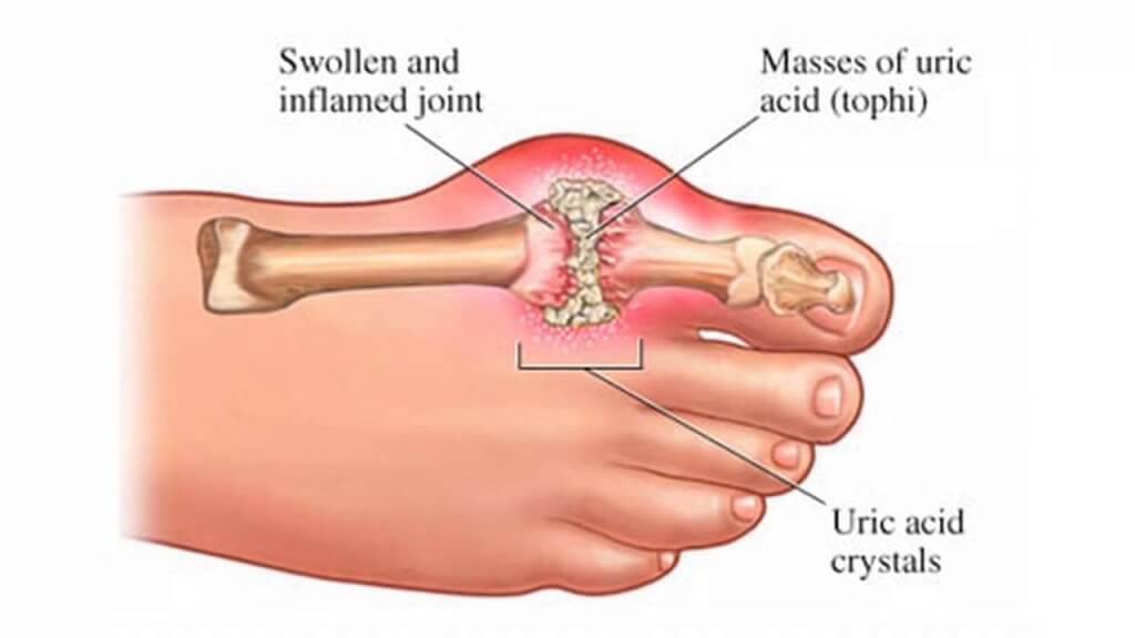 Uric acid crystals in toe cause first gout attack