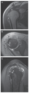 Shoulder in Gout MRI images